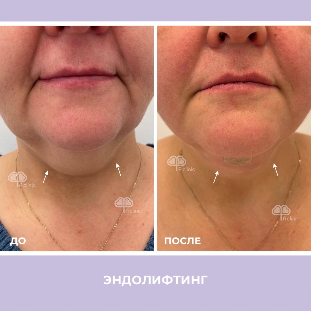 Эндолифтинг. А Клиника