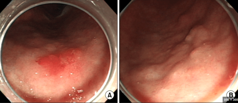 Эндоскопическая картина раннего рака желудка