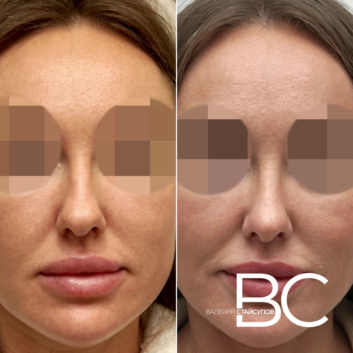 Закрытая ринопластика, пластический хирург Стайсупов В.Ю.