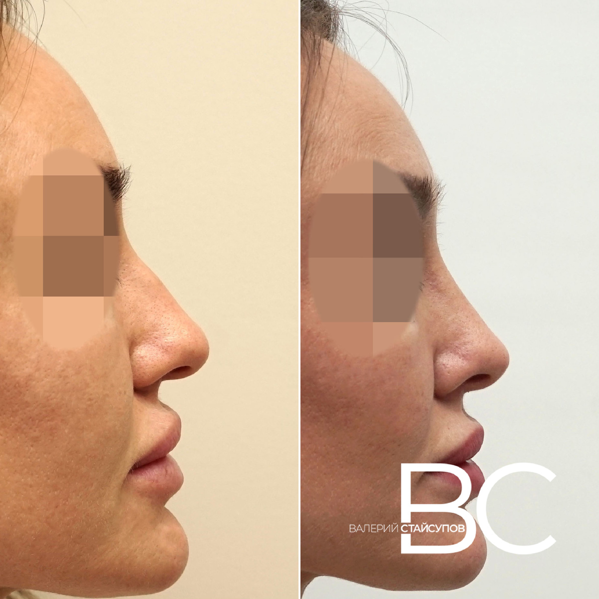 Закрытая ринопластика, пластический хирург Стайсупов В.Ю.