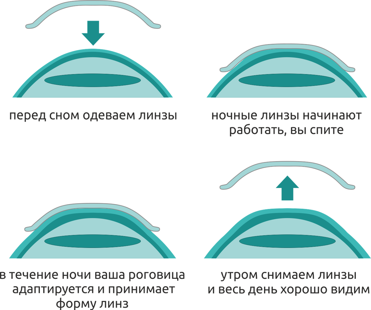 Схема работы ночных линз