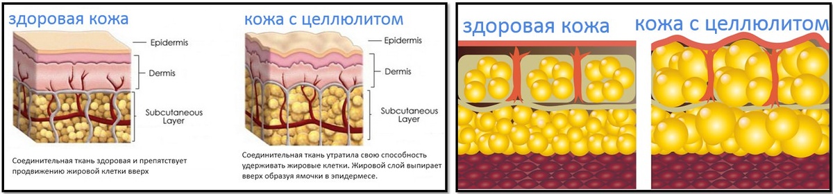 Здоровая кожа и кожа с целлюлитом