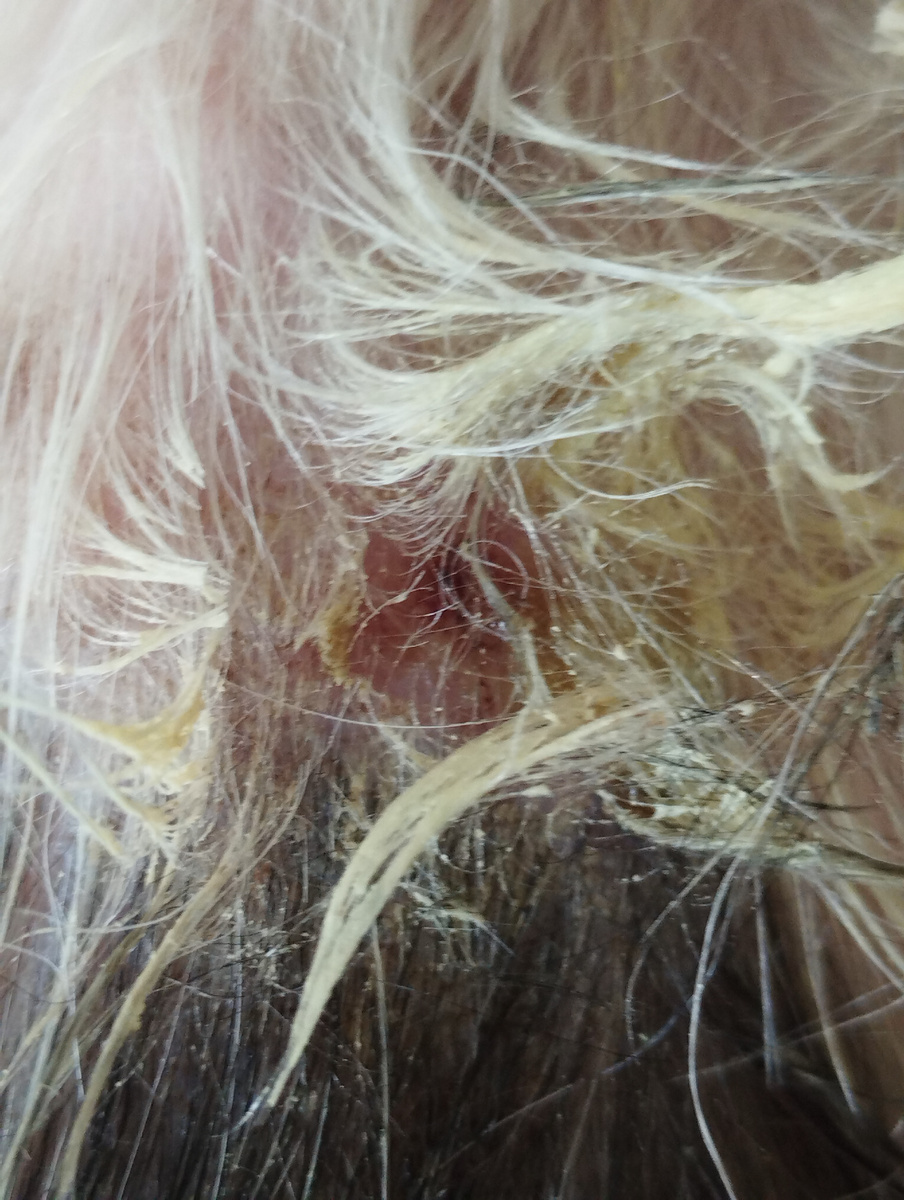 Вот так может выглядеть пиотравматический дерматит. Это очень больно!