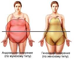 Виды ожирения.