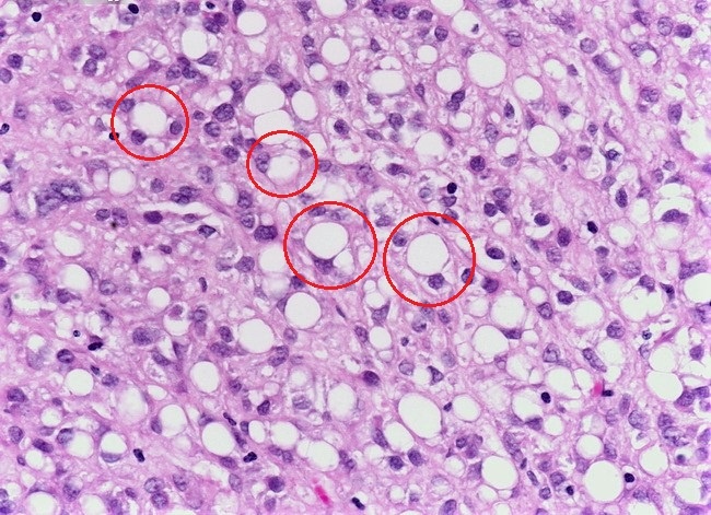 Микроскопическая картина перстневидно-клеточного рака желудка. Фото из открытых источников. 