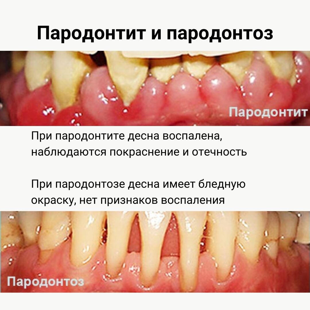 Лечение пародонтоза в Щербинке
