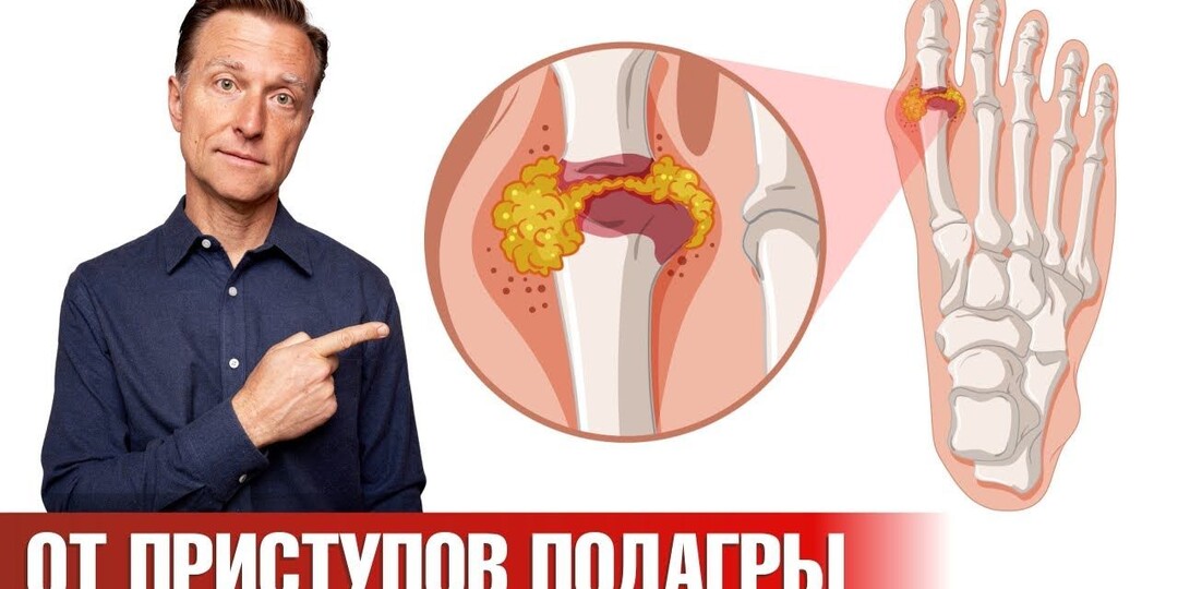 Жизнь без боли: эффективные способы избавиться от подагры