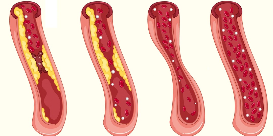 Чистые сосуды – здоровая жизнь: самые эффективные способы избавиться от вредного холестерина