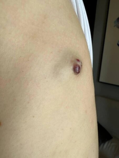 Так опухоль выглядела до операции