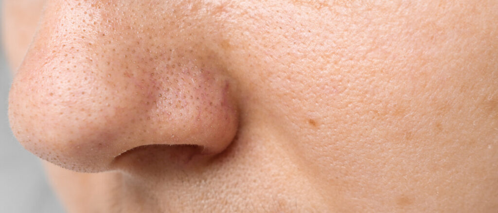 Расширенные поры