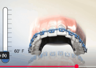 3D анимация работы брекетов с нитинолом