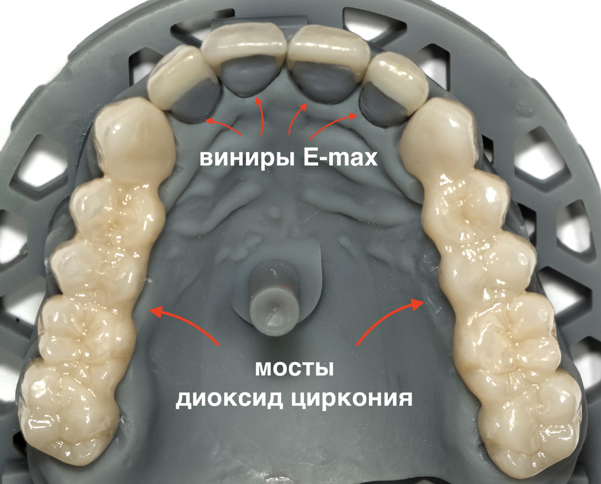 Отличие виниров от коронок (мостовидных конструкций) 