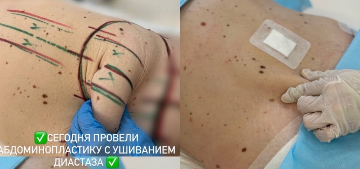 Абдоминопластика с ушиванием диастаза фото до и после. Фото с сайта хирурга Д.Р. Гришкяна. Имеются противопоказания, требуется консультация специалиста