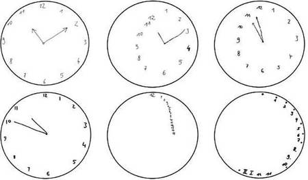При развитии деменции часто рано начинают проявляться ошибки в этом тесте: например, зеркальное расположение цифр, числа 13, 14 на циферблате и т.д. Обычно в этой ситуации и в быту уже заметны проблемы, которые могут встревожить родных. Не нужно ждать, что проблемы исчезнут. Чем раньше вы обратитесь к врачу, тем больше возможностей для лечения.