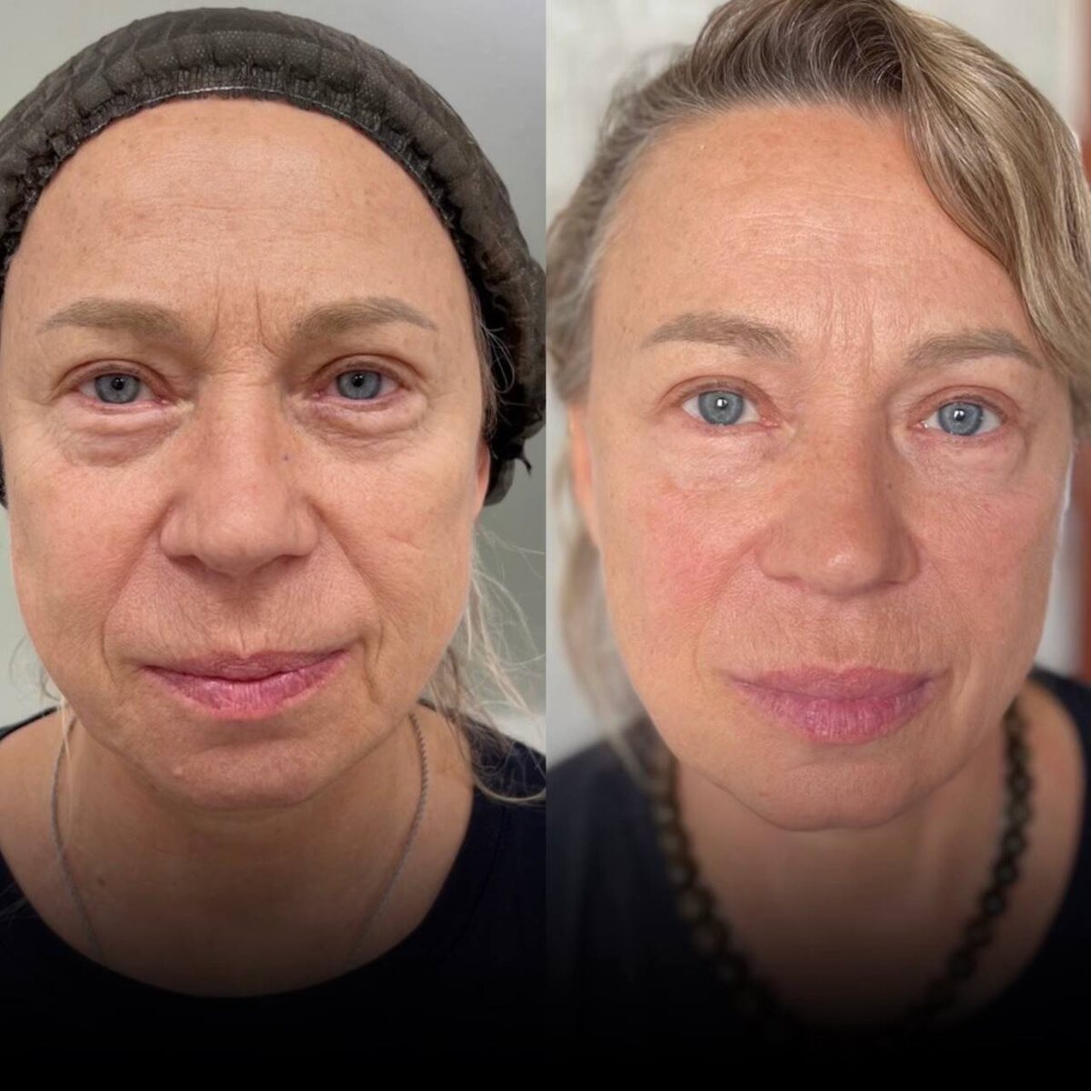 До\после ботулинотерапии full-face