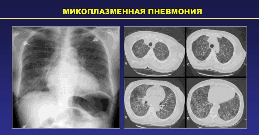    Врачи могут определить чувствительность микоплазмы к семи видам антибиотиков