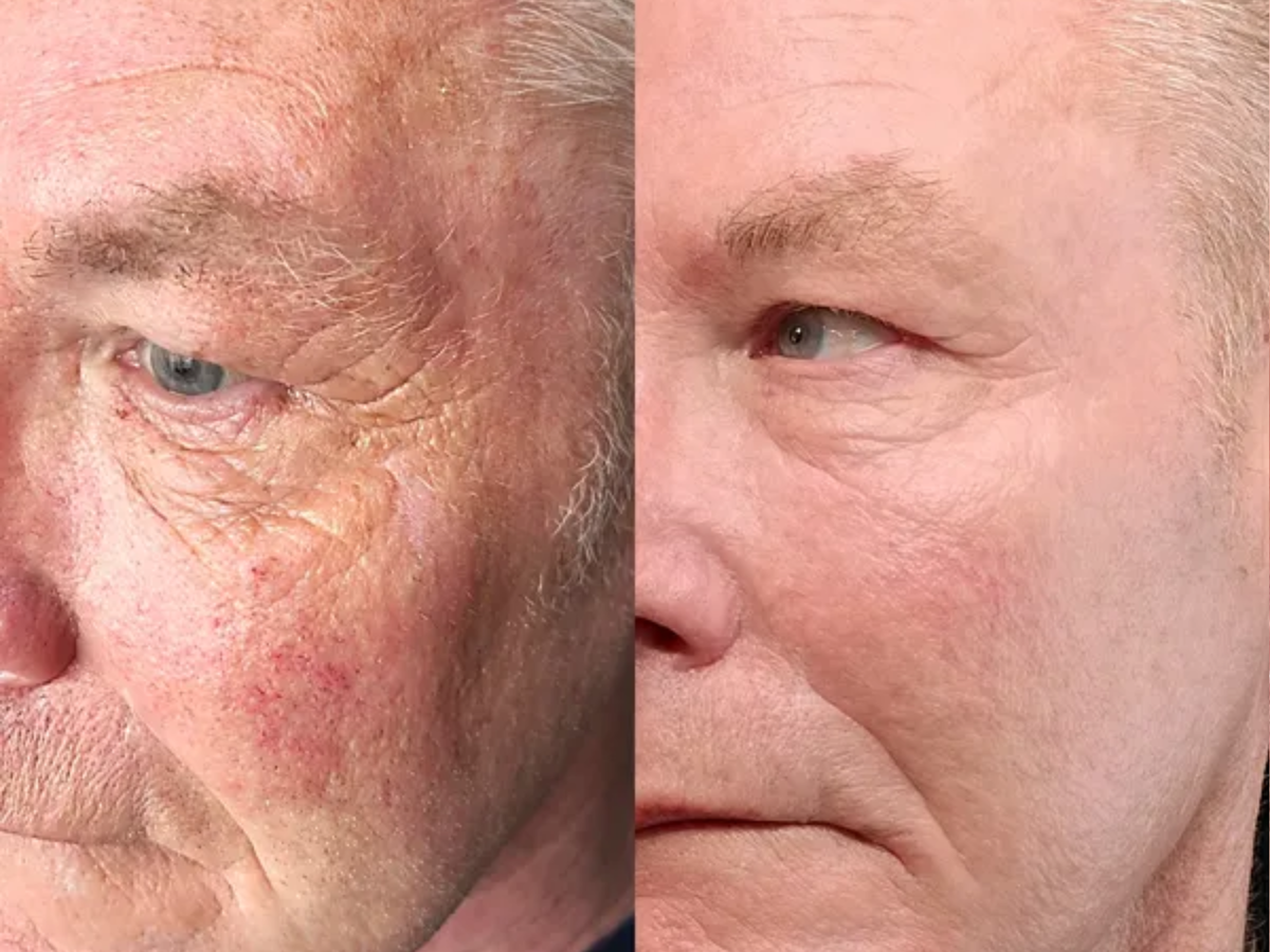 Эффект от курса полимолочной кислоты