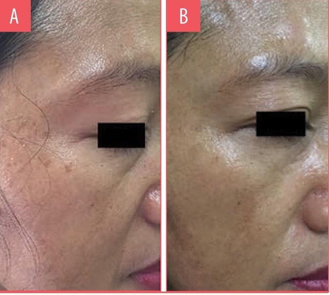 Фото результаты исследования А) до и Б) улучшение после