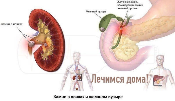 Камни в почках и камни в желчном пузыре