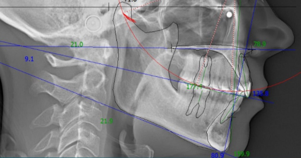 А ваш ортодонт делает расчет ТРГ?