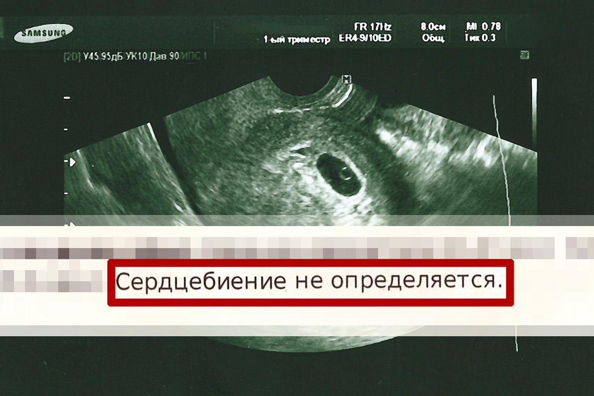 Вместо долгожданного сердцебиения я услышала лишь тишину...