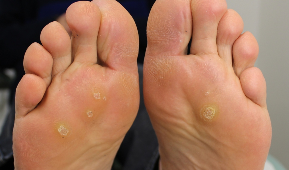 стержневые коренные мозоли на стопах, как бывает