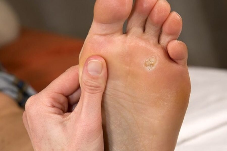 стержневая коренная мозоль, фото для иллюстрации и понимания о чем идет речь