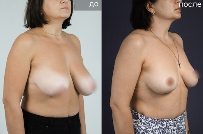 Фото пациентки пластического хирурга Анны Соловьевой