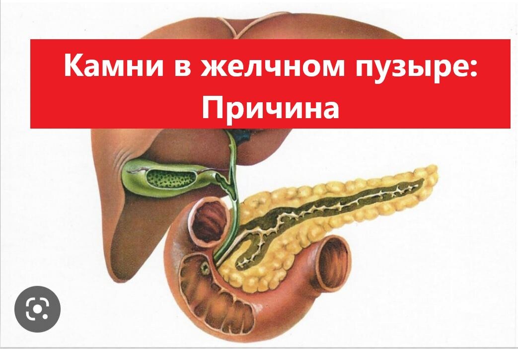 Камни в желчном пузыре: Причина