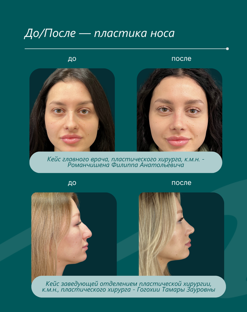Кейсы "До/ После": пластика носа MEDALL