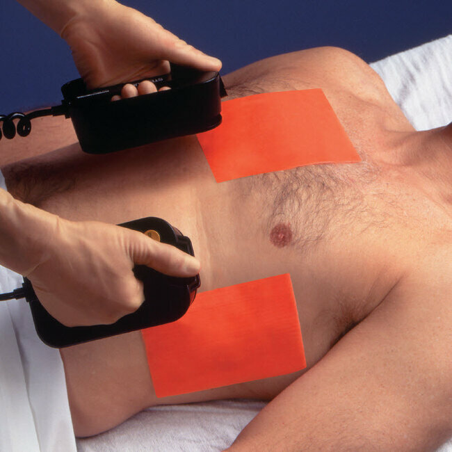 Таким образом, как тут изображено, наоборот - пытаются восстановить синусовый ритм при фибрилляции предсердий. Особенно когда ситуация совсем уж неотложная. Либо когда надежды на медикаментозное восстановление синусового ритма малы