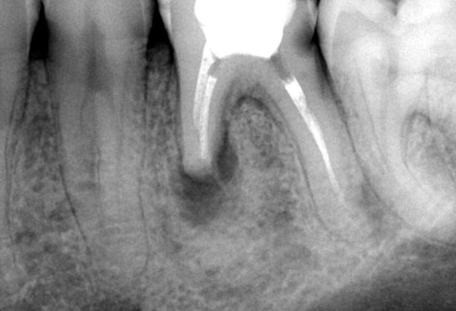 Резорбция корня
