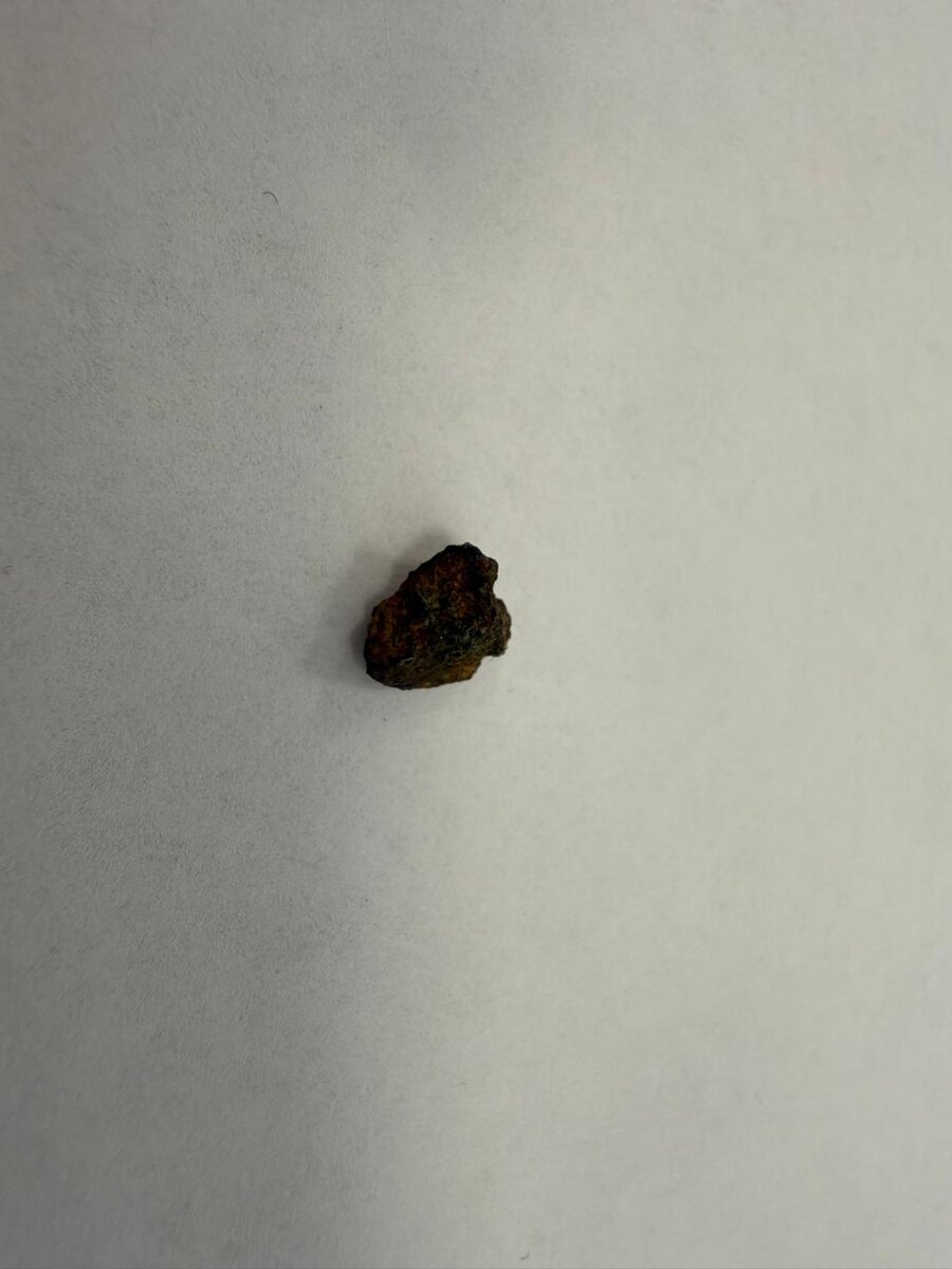 осколок в почке