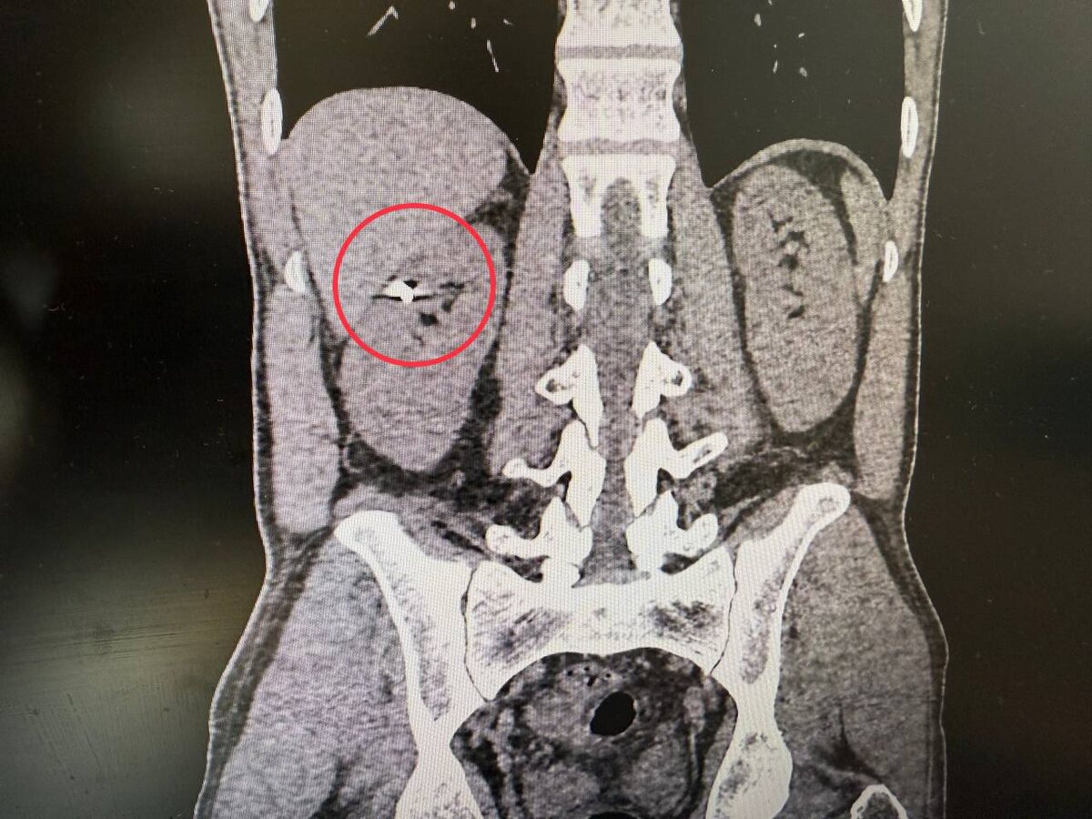 осколок в почке