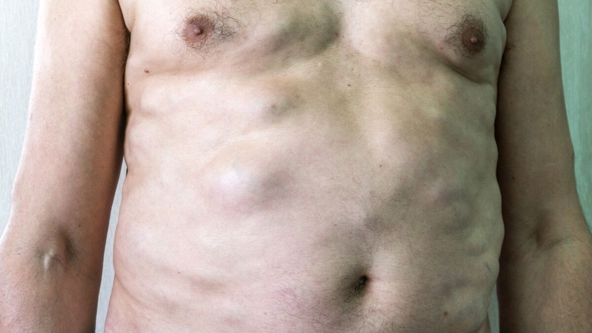 Гроздья винограда и песочные часы: как хирург находит подход к каждой липоме 