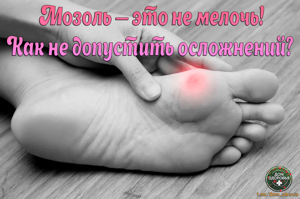 Мозоль — это не мелочь! Что важно знать, чтобы не допустить осложнений