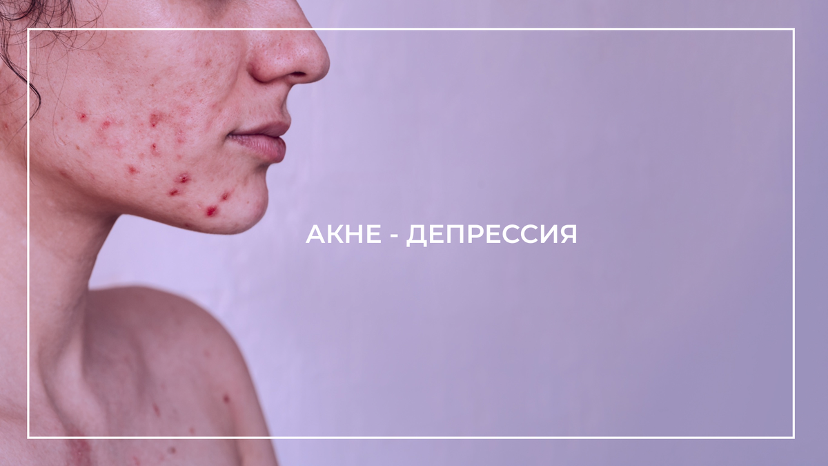 Бывает, даже небольшое количество высыпаний заставляет пациентов страдать