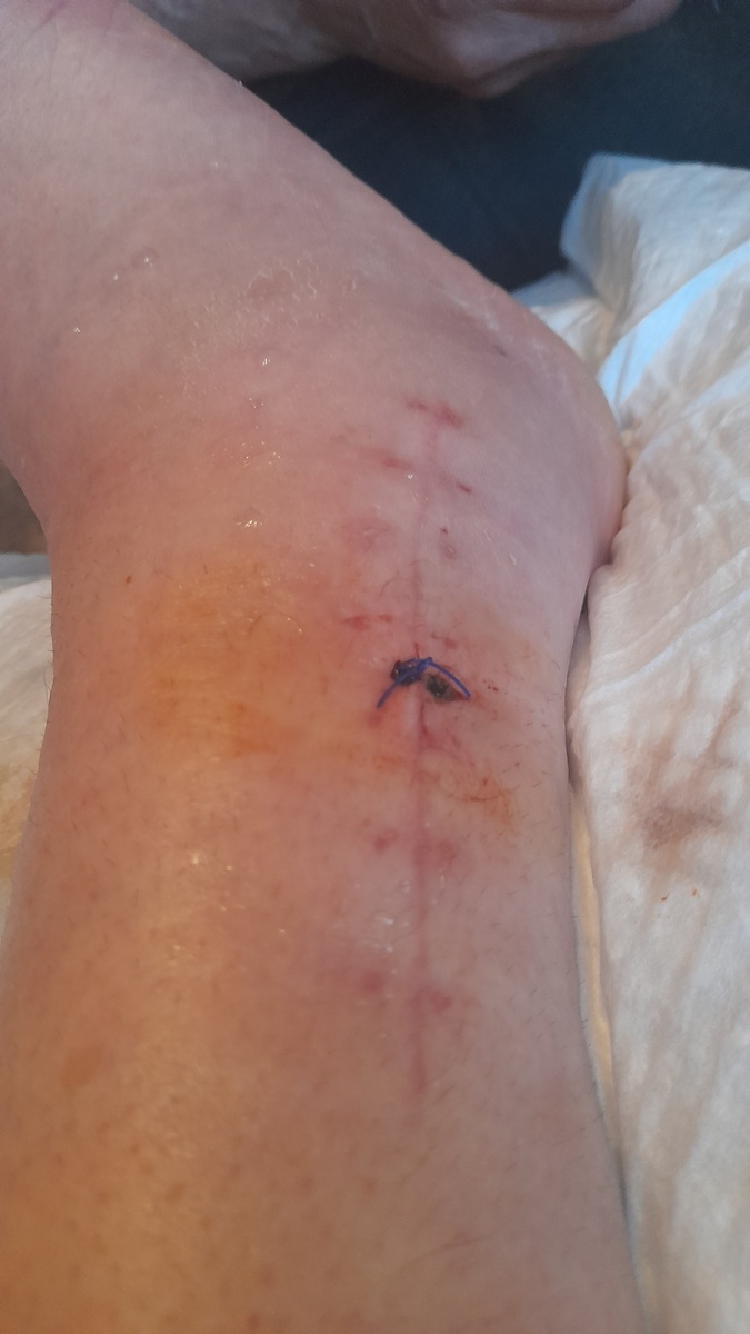 Один шов всего