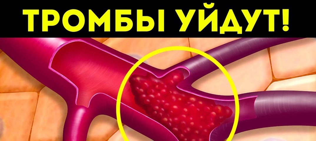 Как помочь организму избавиться от бляшек и тромбов