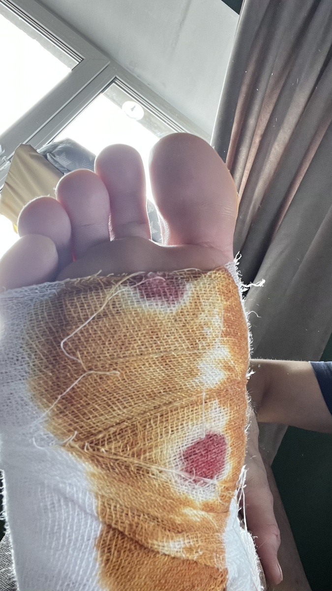 В моём случае я наступил на два гвоздя и один гвоздь пробил ногу насквозь (2024 год)