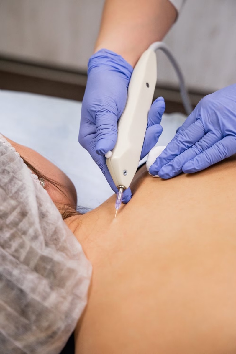 Сосудистый этап. Подкожное введение углекислого газа в области позвоночника - шейно-грудной отел.