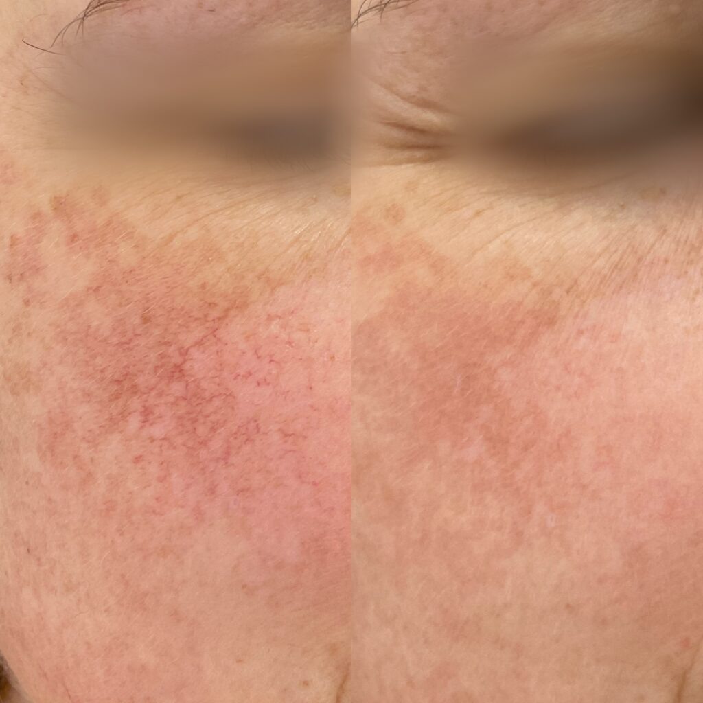 Результат ДО/ПОСЛЕ процедуры BBL