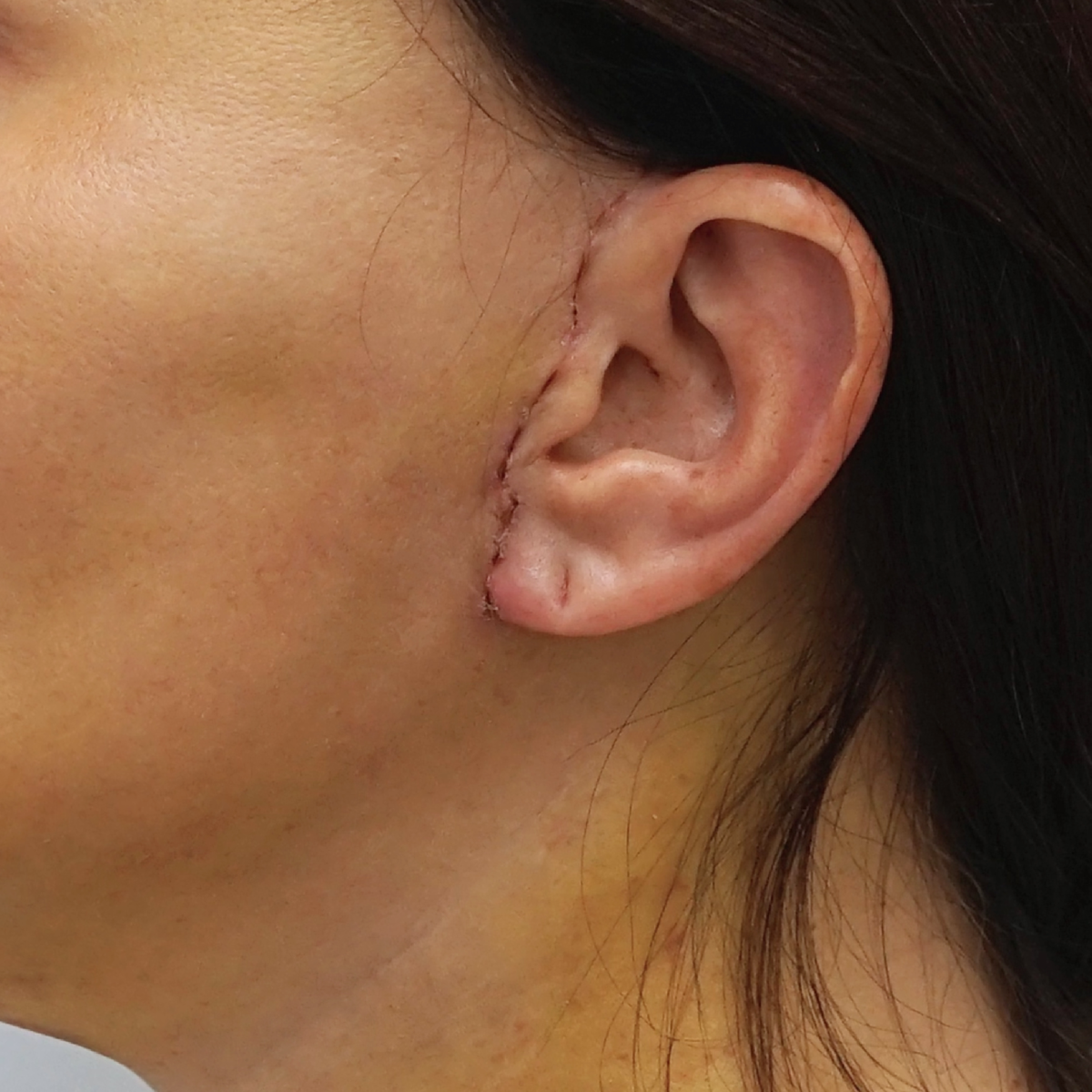 9-ый день после крговой подтяжки лица, пластический хирург Стайсупов В.Ю.