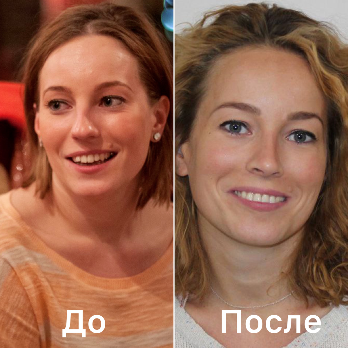 Ринопластика, до и после операции, Пластический хирург Стайсупов В.Ю.