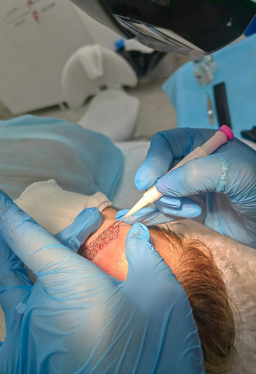 Процесс пересадки волос на брови