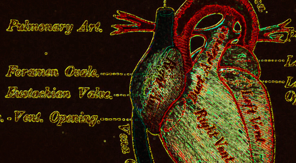   N + 1; Diseases of the heart and circulation in infancy and adolescence, 1888 / Keating, John M., Edwards, William A / Philadelphia : Blakiston / Francis A. Countway Library of Medicine / Open Knowledge Commons and Harvard Medical School / Public domain