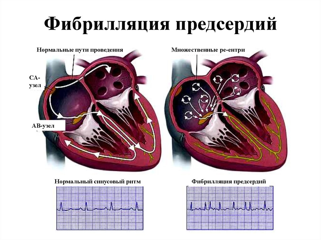 Симптомы и лечение фибрилляции предсердий. Источник: https://mosgormed.ru/fibrillyacziya-predserdij/