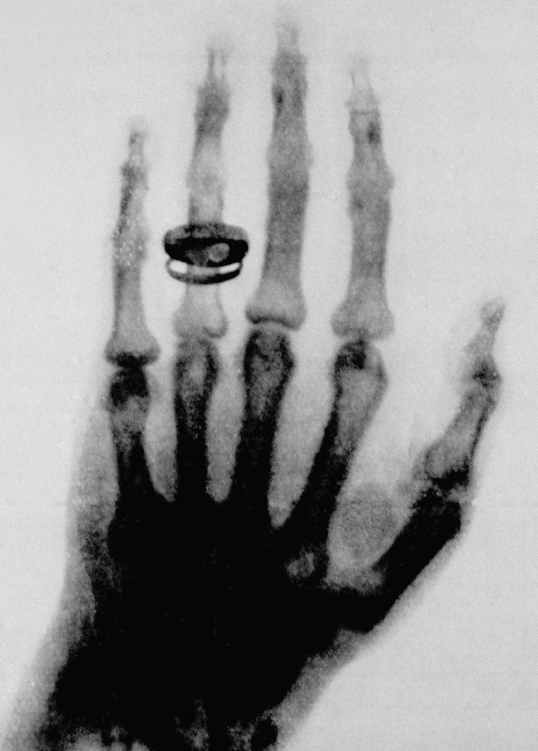 Снимок руки жены Рентгена