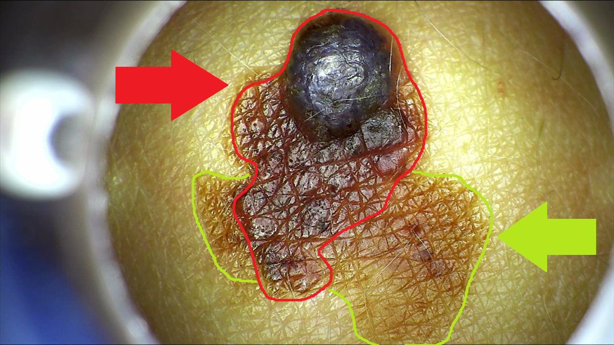 Красным цветом обведены приблизительные контуры меланомы, салатовым - кератомы, на месте которой возникла опухоль