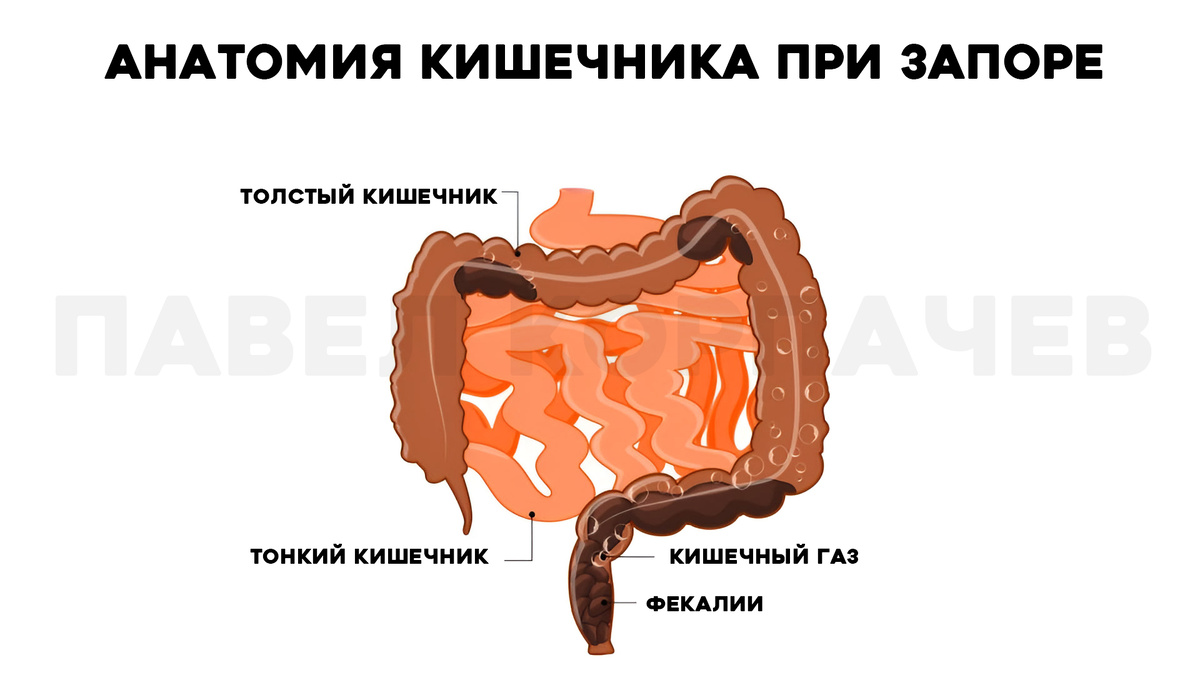 Схема наглядно показывает, как в случае запора каловые массы и газы накапливаются в толстом кишечнике, вызывая дискомфорт и затруднения при походе в туалет. 